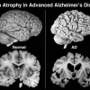 Alzheimer