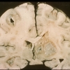 Absceso cerebral