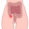 Apendicitis