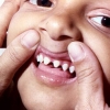 Desarrollo anormal de los dientes