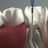 Endodoncia