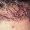 Foliculitis