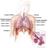 Enfisema, síntomas, causas y tratamiento