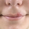 Herpes labial