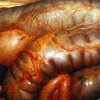 Megacolon tóxico