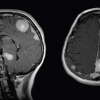 Neurofibromatosis 2