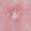 Queratosis actínica